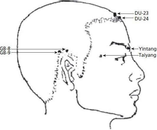 Craneopuntura: protocolo de tratamiento de acupuntura para los trastornos de ansiedad: reporte de un caso.