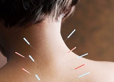 La acupuntura eficaz para los trastornos de la columna cervical