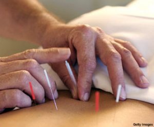 Ayuda de la emergencia de la acupuntura para la apendicitis