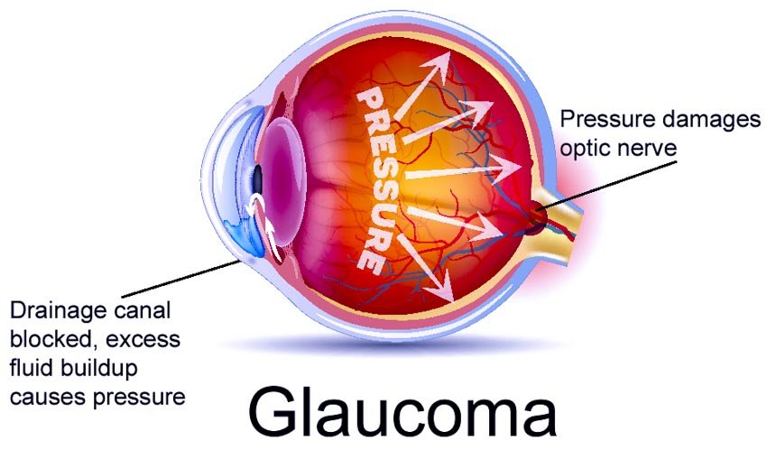 Acupuntura para la protección de la vista glaucoma