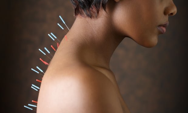 Dolores y agujas: los escáneres cerebrales apuntan a efectos ocultos de la acupuntura